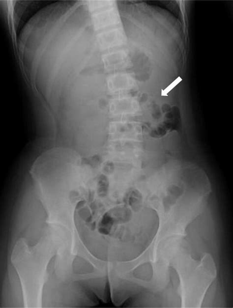 Colocolic intussusception secondary to pneumatosis cystoides intestinalis: the role of abdominal ...