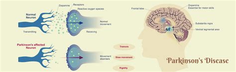 How Grocare Is Slowing Down Progression In Parkinson's Patients With ...