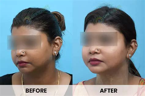 Results of cosmelan | Before After Results of cosmelan peel treatment