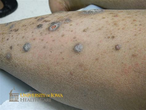 Thick hyperpigmented to violaceous polygonal papules and plaques, some with central erosion on ...
