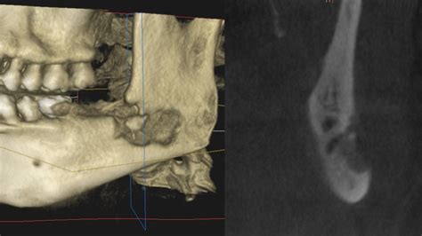 osteomyelitis of jaw bone traumatic tooth extraction infection bone ...