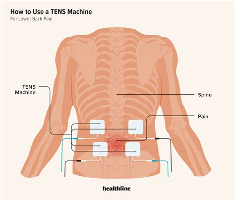 Tens Unit Placement For Pelvic Floor | Viewfloor.co