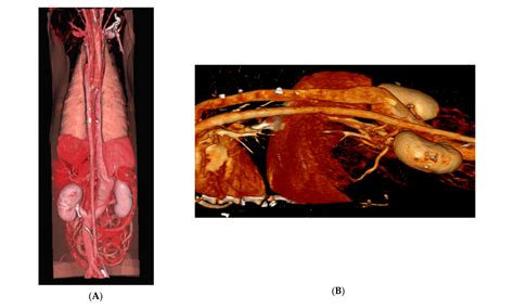 Resolution of Exercise-Induced Syncope After Stenting of the Azygos ...
