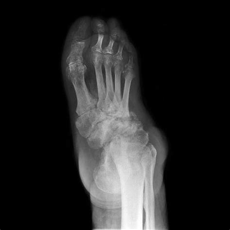 Image:Neuropathic Arthropathy of the Foot-Merck Manual Professional Edition