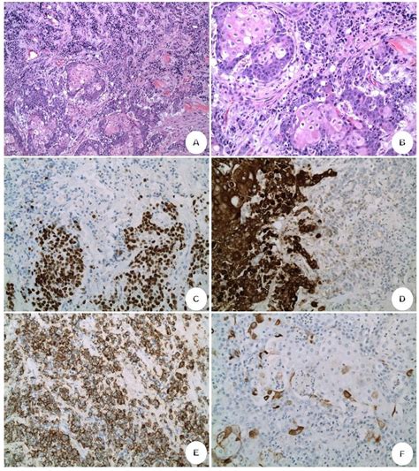 NUT Midline Carcinoma: Morphoproteomic Characterization with Genomic and Therapeutic Correlates