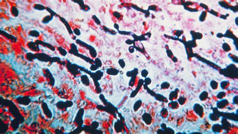 Esophageal Atresia: How to know if your child suffers from this ...