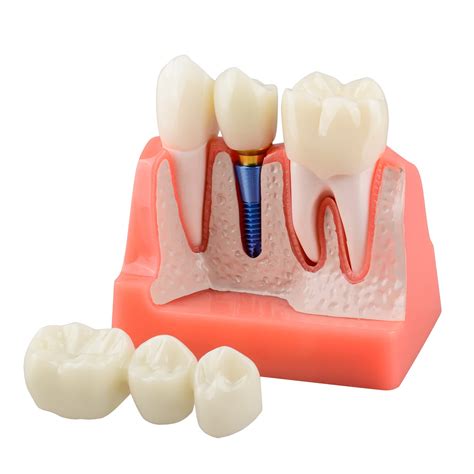 Dental Implant Crown