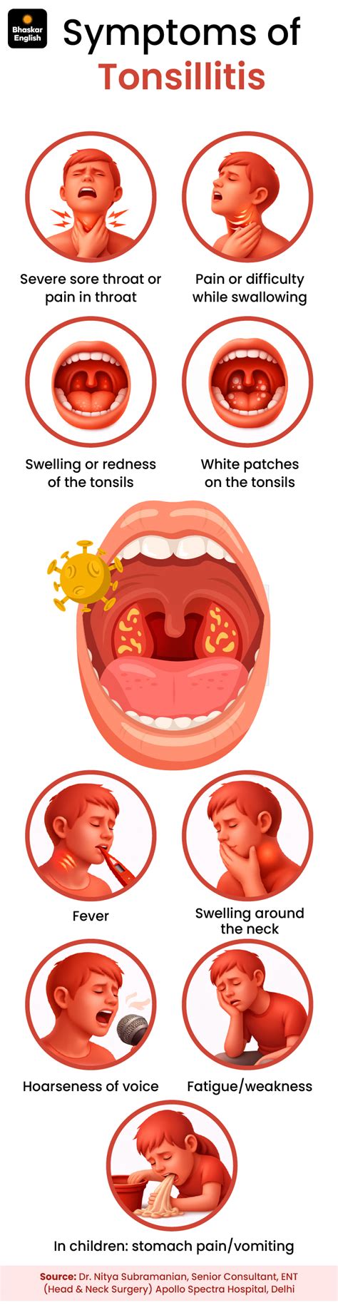 Tonsillitis: Doctor Explains Symptoms, Causes & Prevention
