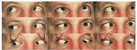 Image result for Intractable Diplopia