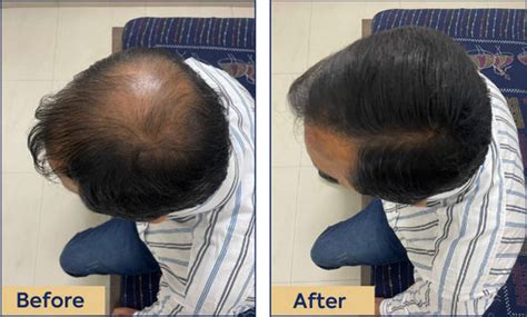 Hair Building Fiber for Thinning Hair & Bald Spots | Adomour