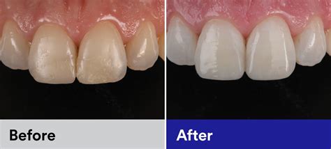 Anterior Restoration | Dental Products | 3M India