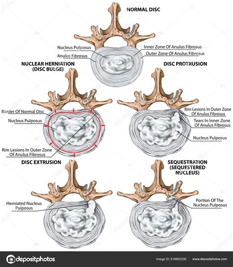 Tipos De Hernia Discal – Hernie Discale Définition – RQHSTJ