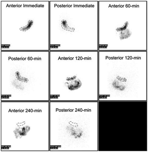 Gastric Emptying Scintigraphy | Journal of Nuclear Medicine Technology
