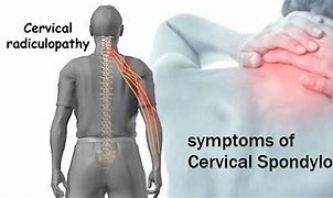 Image result for cervical spondylosis