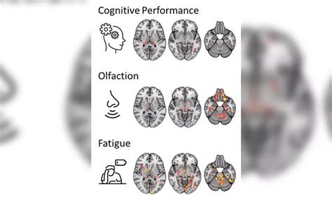 New MRI study reveals how brain changes in long-Covid patients