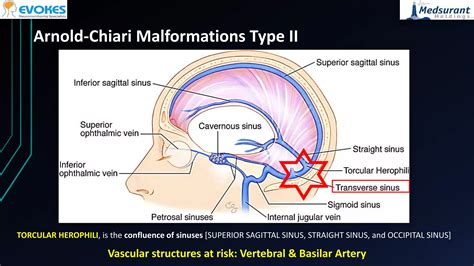 Improved transcranial motor evoked potentials after craniovertebral decompression in chiari ...
