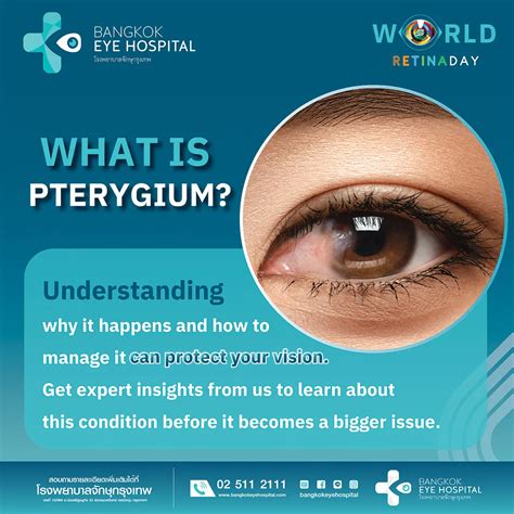 Pterygium: Causes, Symptoms, and Treatment | What You Need to Know