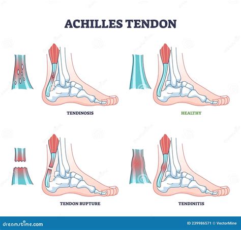 Tendon Damage In Ankle