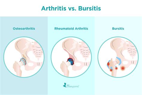 What’s the Difference Between Arthritis and Bursitis?