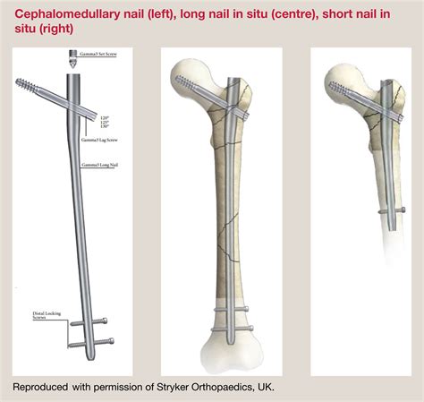 Fractures of the hip in younger adults - Surgery - Oxford International ...