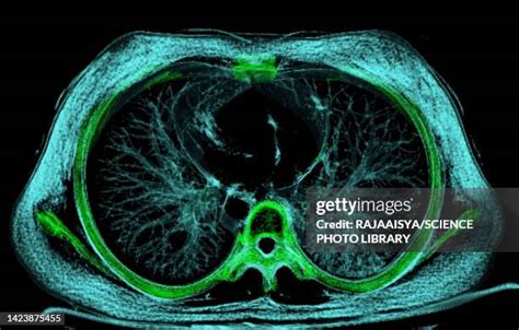 Image result for Normal Profile CT