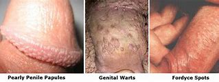 Pearly penile papules removal treatments at home. 