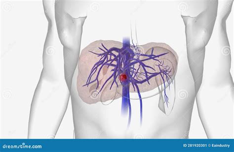 Portal Vein Thrombosis (PVT) is the Occlusion of the Portal Vein by a Blood Clot (thrombus Stock ...