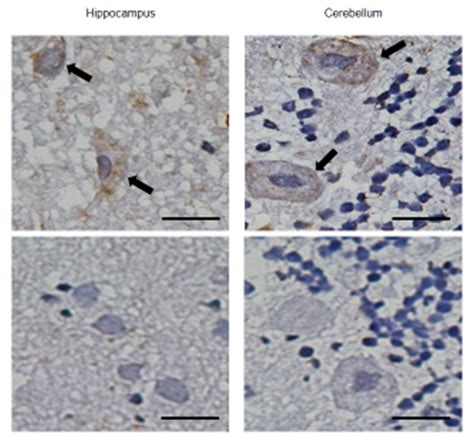 Enzyme Replacement Therapy with Pabinafusp Alfa for Neuronopathic ...