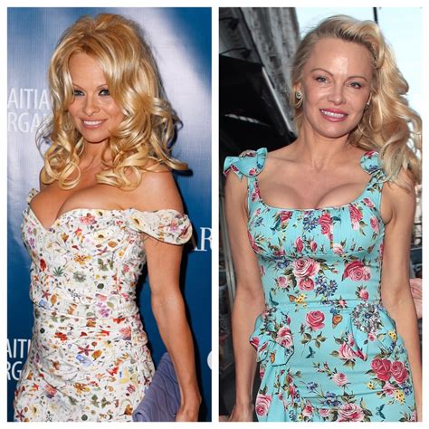 Pamela Anderson Before and After Plastic Surgery — See New Pics!
