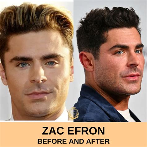 Zac Efron Haartransplantation - Hair Center of Turkey