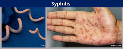 Syphilis - Benton Franklin Health District