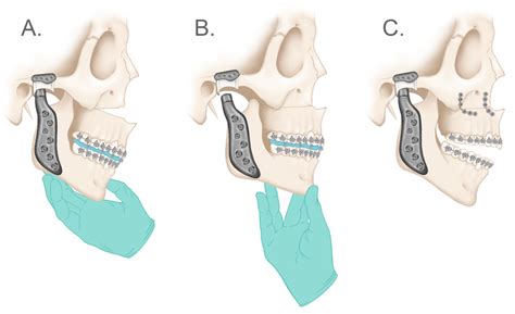 Concomitant Temporomandibular Joint Replacement and Orthognathic Surgery