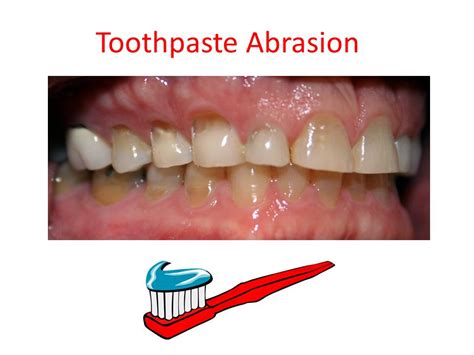 Image result for Cancer-Causing Toothpaste