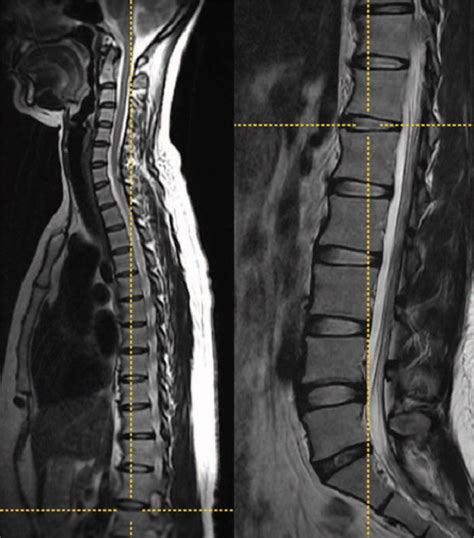 A Review of Symptomatic Lumbosacral Transitional Vertebrae: Bertolotti ...