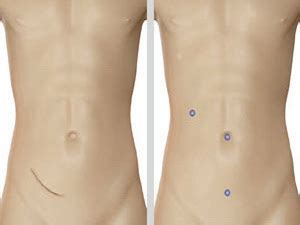 Appendix Surgery in Nadiad | Krishna Hospital