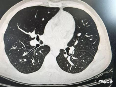 肺磨玻璃结节的生长速度如何，会不会突然变成晚期肺癌？ - 知乎