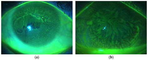 Diagnostic Algorithm for Surgical Management of Limbal Stem Cell Deficiency