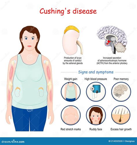 Cushing's Syndrome Selfcare