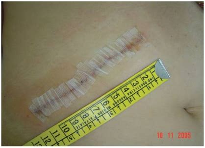 Image result for Flank Incision Nephrectomy