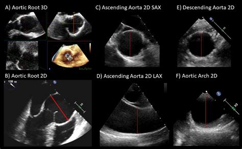 Thoracic Aorta Measurements Using Intraoperative Transesophageal Echocardiography: Validation ...
