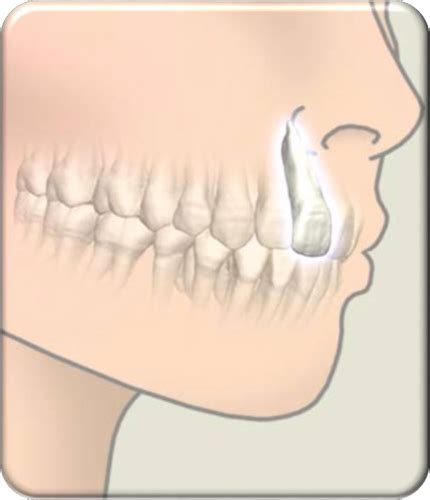 Image result for Contralateral Teeth