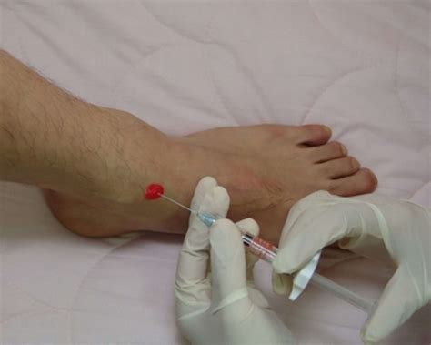 Image result for Ankle Anterolateral Approach Injection