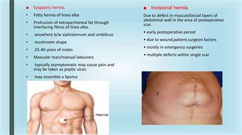 VENTRAL WALL HERNIA.pptx