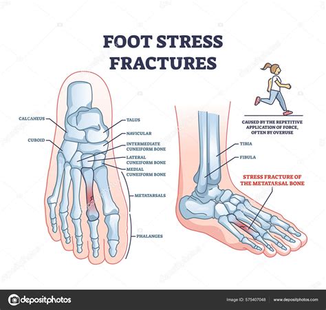 Foot Stress Fracture