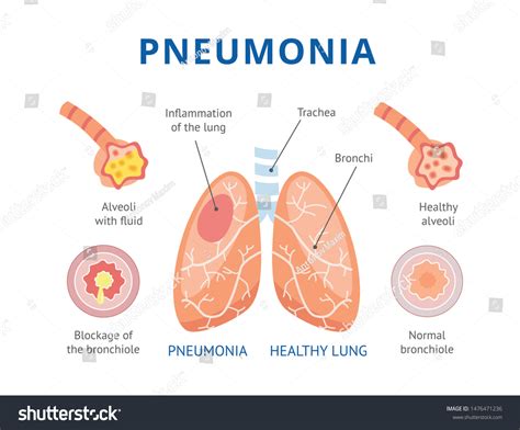 Medical Infographics Human Pneumonia Lungs Healthy 库存矢量图（免版税）1476471236 | Shutterstock