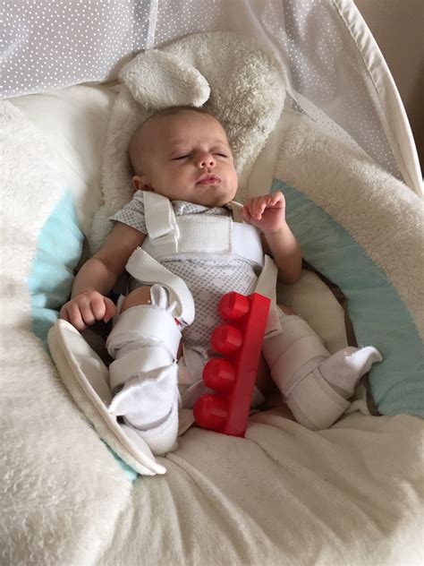 How To Dress Baby With Hip Dysplasia at Rose Slaughter blog