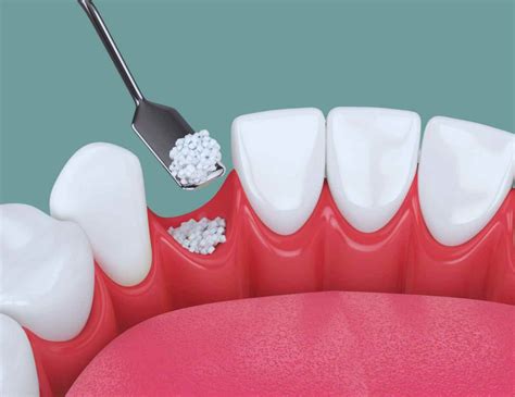 Everything You Need to Know About Bone Graft Dental Surgery - crystalline Dental