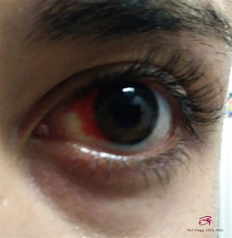 Why Do Blood Vessels Break In The Eye - Infoupdate.org