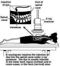 Image result for Myelogram Injection