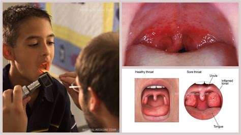 Child Carrier Of Strep Throat at Sebastian Nanson blog